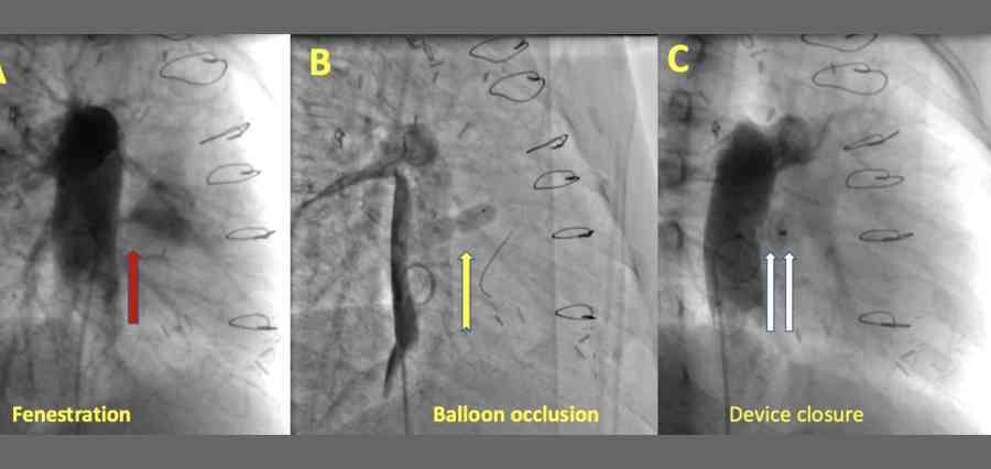 Orphaned by COVID-19, Medica treats successfully 11-year-old girl by unique innovative rotational angiogram